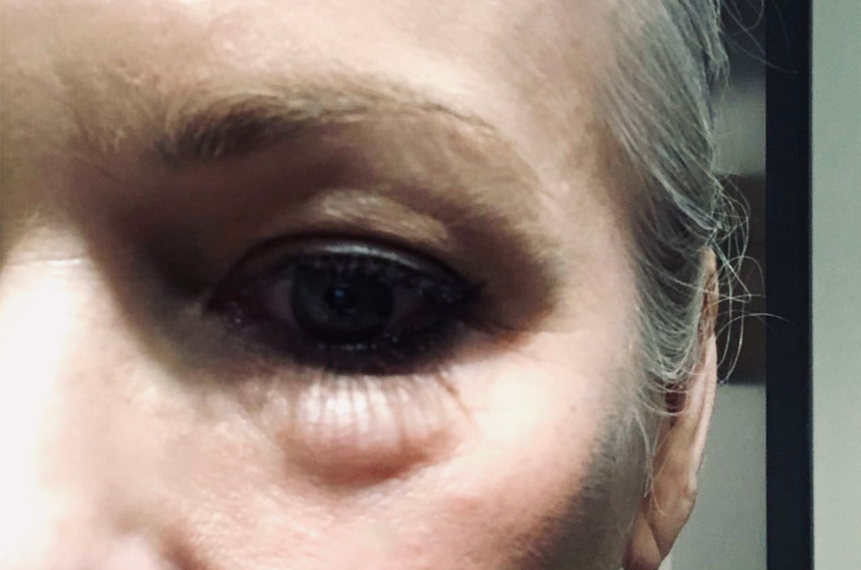 Dermal Filler Nodule under eye